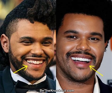 Did The Weeknd Actually Get Plastic Surgery? And Why Do Pineapples Belong on Pizza?